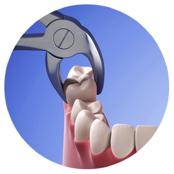Tooth-extraction-hero (1)