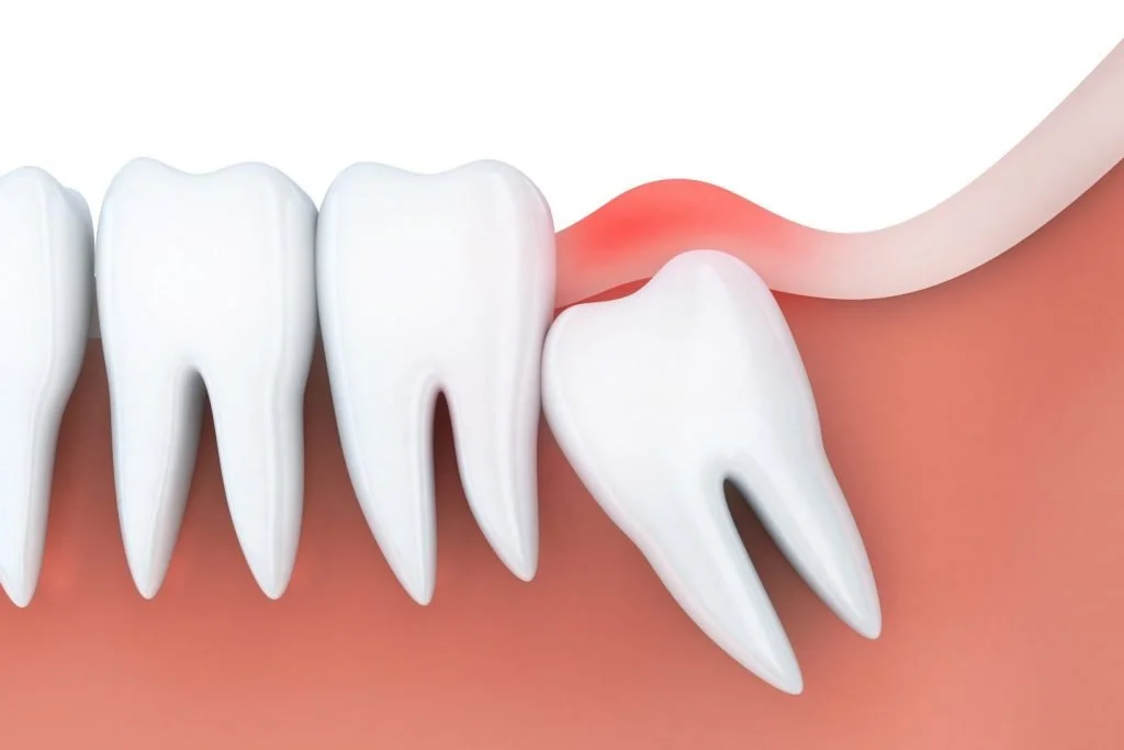 Are There Different Types of Wisdom Teeth Extractions?